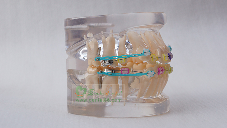 TM-B2-03 Orthodontic Model